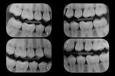 Radiografia Interproximal