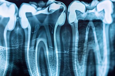 Radiografia Periapical